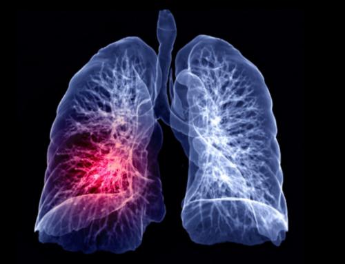 Las diferentes opciones para cáncer de pulmón avanzado
